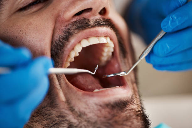 Best Emergency Dental Extractions in Zionsville, IN